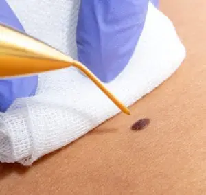 cryopen treatment Hertfordshire
