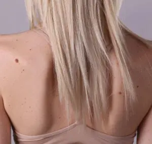 Skin Tag Removal Tring