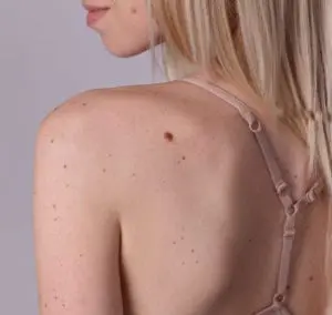 Skin Tag Removal Berkhamsted