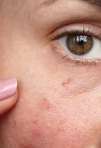 Red facial veins