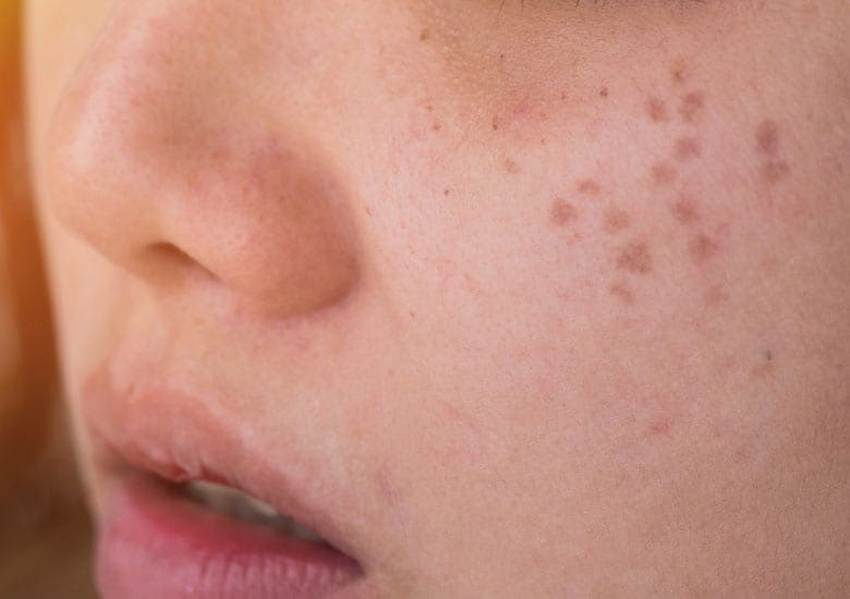 Freckles Flat Spots Harpenden Skin Clinic St Albans Hertfordshire 