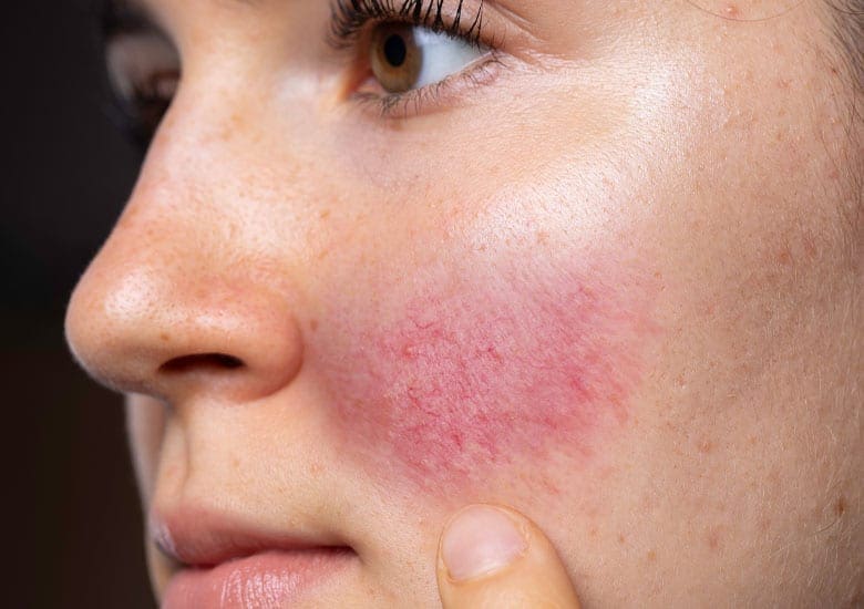 Rosacea Skin Flush Harpenden Skin Clinic St Albans Hertfordshire